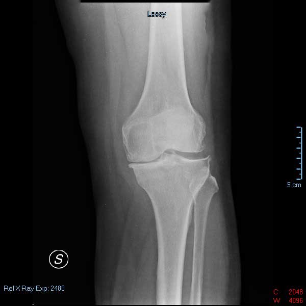 Ortopedia web artrosi ed artrite del ginocchio